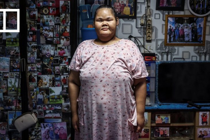 Indonesia confronts childhood weight epidemic